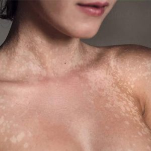 Bệnh lang ben thường hay xuất hiện ở cổ và ngực